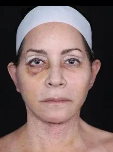 MILA patient recovery journey, Patient 3 — 1 week