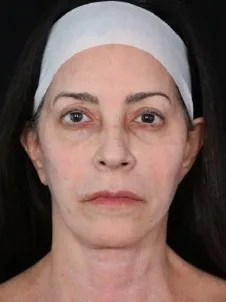 MILA patient recovery journey, Patient 3 — 90 days