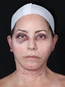 MILA patient recovery journey, Patient 3 — Day 1