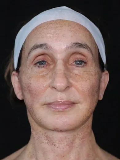MILA patient recovery journey, Patient 4 — 1 week