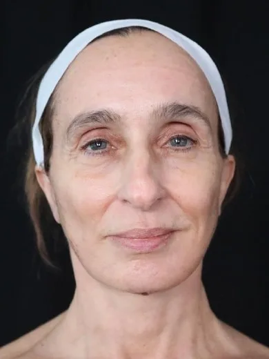 MILA patient recovery journey, Patient 4 — 90 days