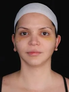 MILA patient recovery journey, Patient 5 — 1 week